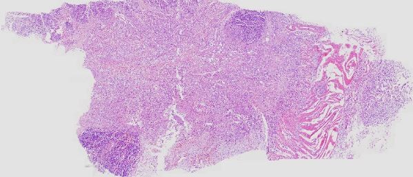 Pancreatic cancer-60